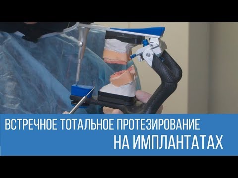 Встречное тотальное протезирование на имплантатах. Диагностика, подготовительный этап.