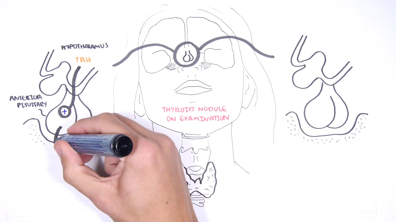 Approach to a Thyroid Nodule - causes, investigation and treatment