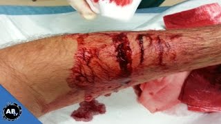 My Worst Snake Bite Ever! EP. 422 SnakeBytesTV : AnimalBytesTV