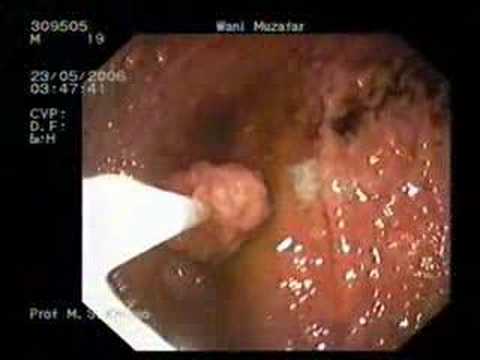 Multipe Tumors Endoscopic Excision In PJS 