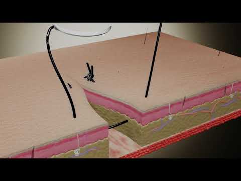 Suture Techniques - Horizontal Mattress U-Shaped Suture
