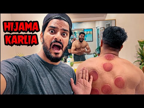 Hijama Karlia 😯 | Kitna Blood Nikla? | Mishkat Khan (The Fun Fin)