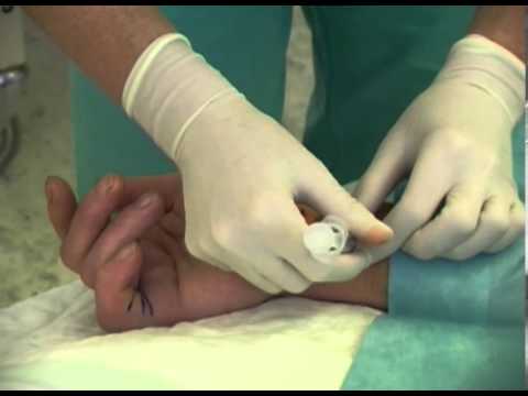 Die Behandlung der Dupuytren'schen Kontraktur mit XIAPEX 1.Teil