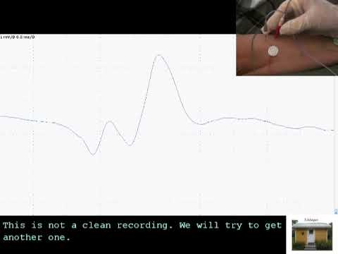 SFEMG - Stimulation EDC  (Joze Trontelj)