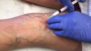 Watch This Vein Disappear - Sclerotherapy Vein Removal