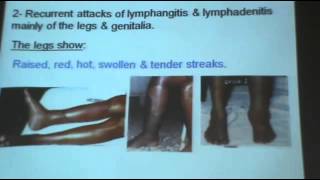 Dr Azaa  Nematodes 7   Filaria wuchereria Bancrofti   YouTube