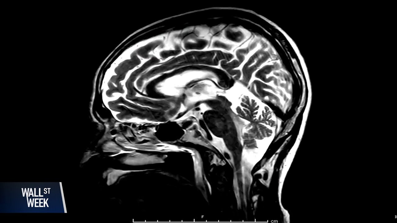 The Reality of Alzheimer's Research