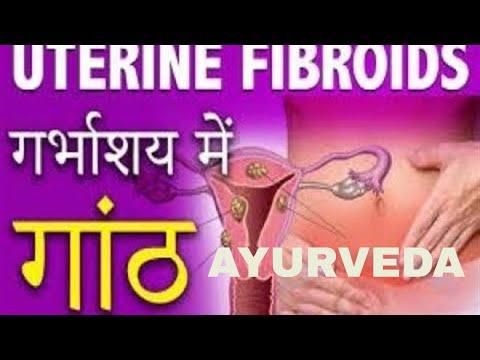 uterus fibroid treatment without surgery in hindi/बच्चेदानी में गांठ का इलाज/part2 Video