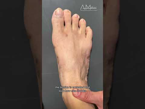 Can THIS Man's Bunion be Cured With an AMI® Procedure??