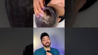 Doctor Reacts to Dandruff Hack | Doctorly #shorts