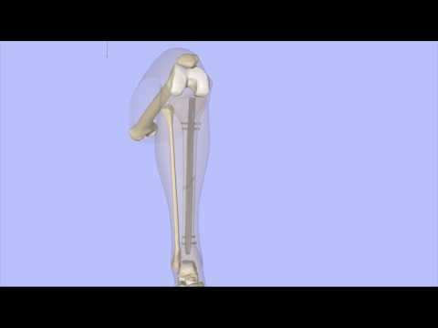 Tibial Intramedullary Nailing