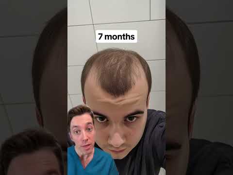 Calling BS on “Just Minoxidil”?