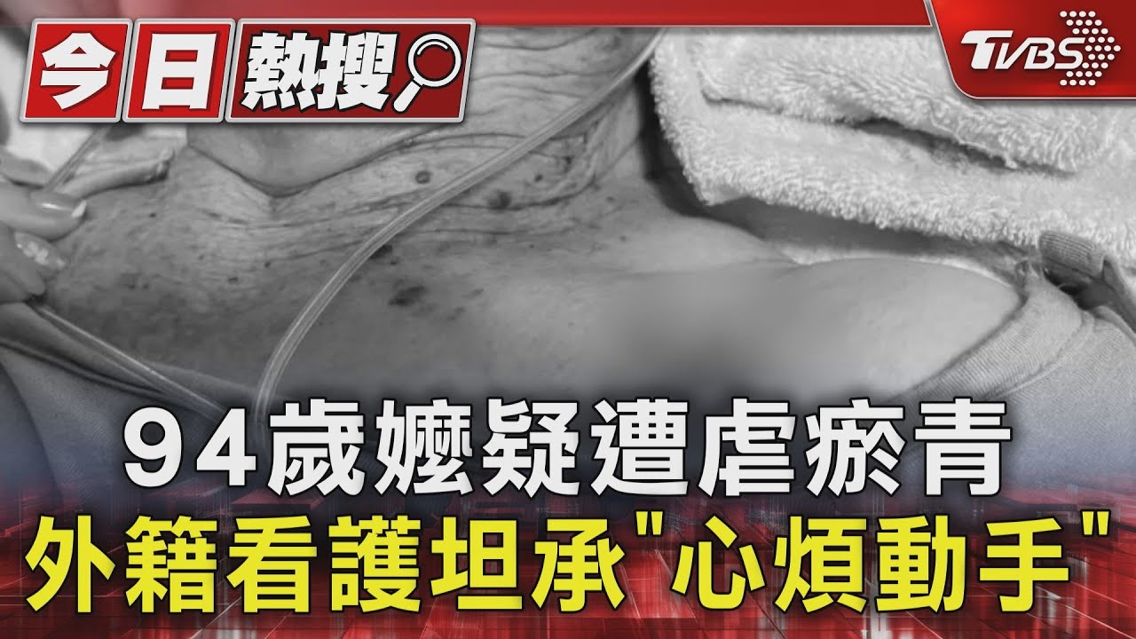 94歲嬤疑遭虐瘀青 外籍看護坦承「心煩動手」