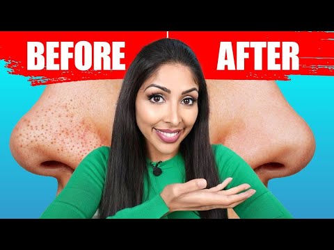 SHRINK PORES fast | Dr Vanita Rattan