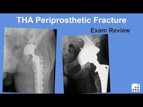 Periprosthetic Fracture Exam Review - Wayne Paprosky, MD