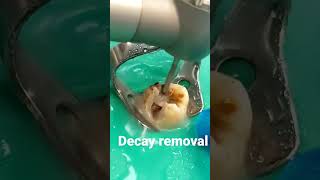 Decay Removal #toothdecay #decay #toothache #shorts #teethfacts
