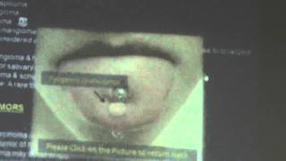 31) Dr.Wael Shawky 22-2-2016 [ Diseases of the Oral Cavity and Salivary Glands ]