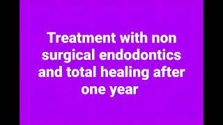 Endodontic treatment of huge periapical lesions.
