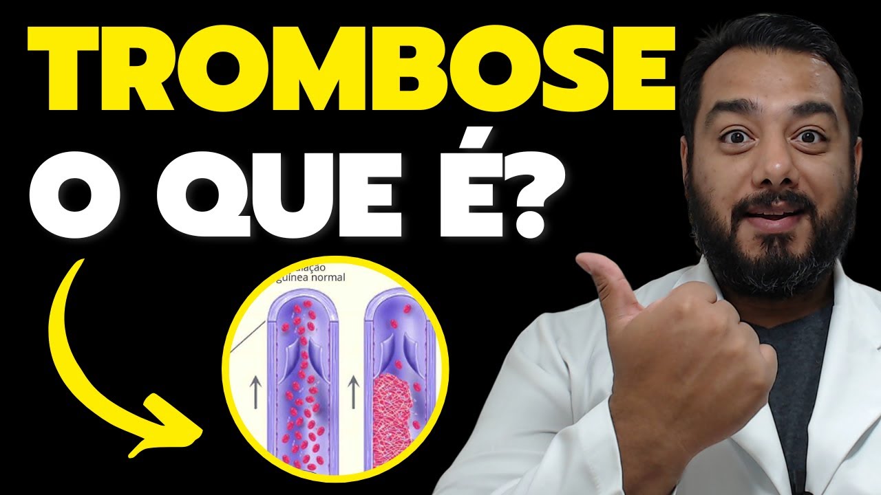 O que é trombose venosa profunda (TVP)? Assista e Entenda! | Prof. Dr. Victor Proença - IBAP Cursos