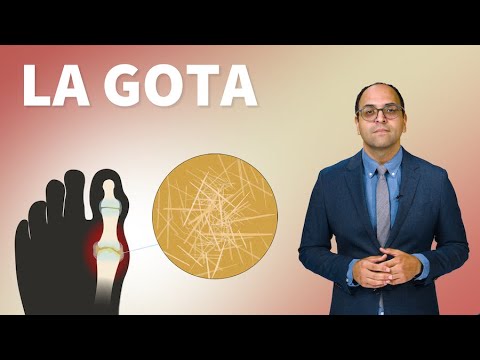 La gota: ¿Qué es y a quién afecta?
