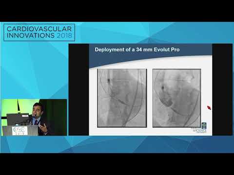 CVI2018 Session: A Challenging Case of Bicuspid Aortic Stenosis - Allen C. Rassa MD