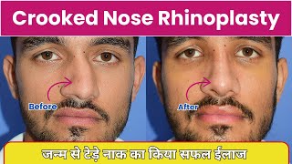 टेड़े नाक को बनाया सुन्दर नाक देखे मरीज की खुशी | Crooked Nose Rhinoplasty | Dr Sunil Tanvar