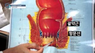 [기획취재] 치루, 원인은 무엇인가?