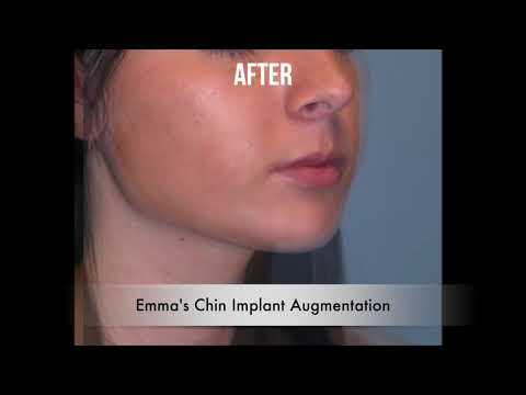 Chin Implant Augmentation: Patient Video Testimonial thumbnail
