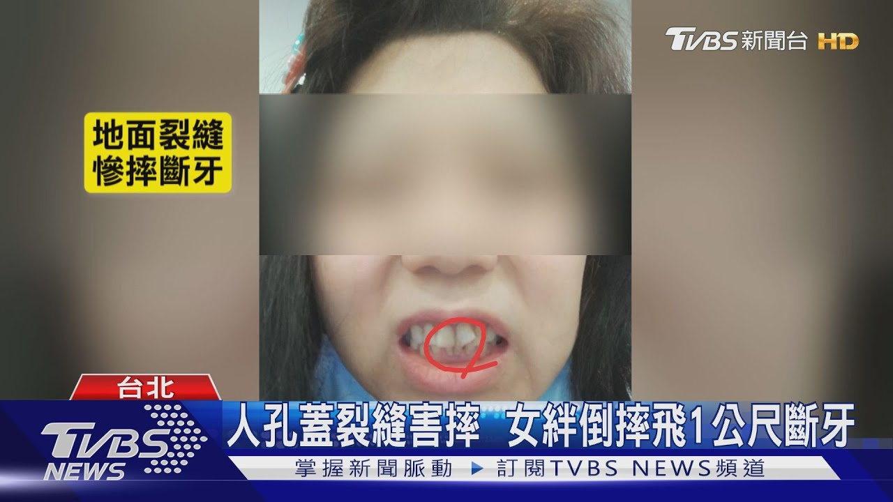 人孔蓋裂縫害摔 女絆倒摔飛1公尺斷牙
