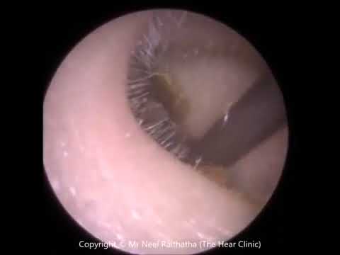 185  Jobson Horne Removal of Ear Wax from Entire Ear Canal   Mr Neel Raithatha THe Hear Clinic
