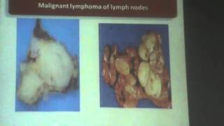 47) Dr.Yasmeen 7/4/2016 [ Non-hodgkins lymphomas ]