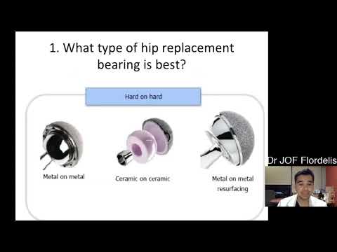 @everyone The choice of hip replacement bearing, or the material that forms the surfaces of the hip