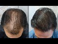 5653 FU's. Hair Transplant by FUE Technique ...