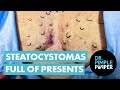 Steatocystomas Full of Presents