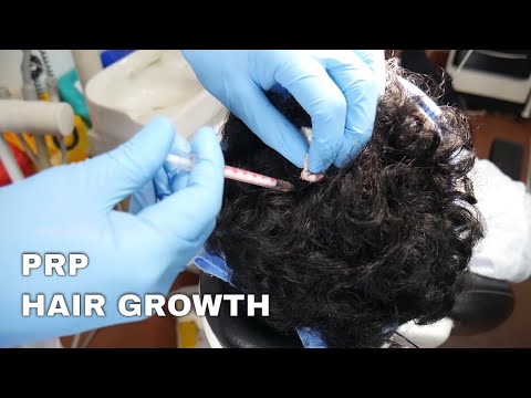 Getting Back Your Lost Hairs Easily - PRP Hair Loss Treatment