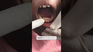 KÖPEK BALIĞI DİŞİ SENDROMU !