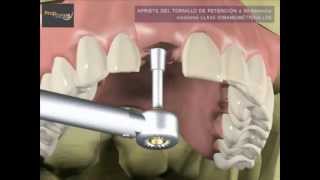 ¿Como se hace la prótesis sobre implantes dentales?