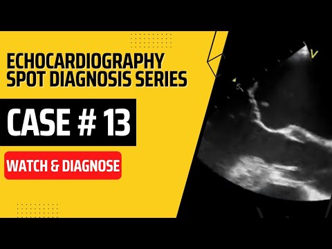 Case 13: Echocardiography Spot Diagnosis Case Series  #echocardiography #echo #fcpsquestionbank