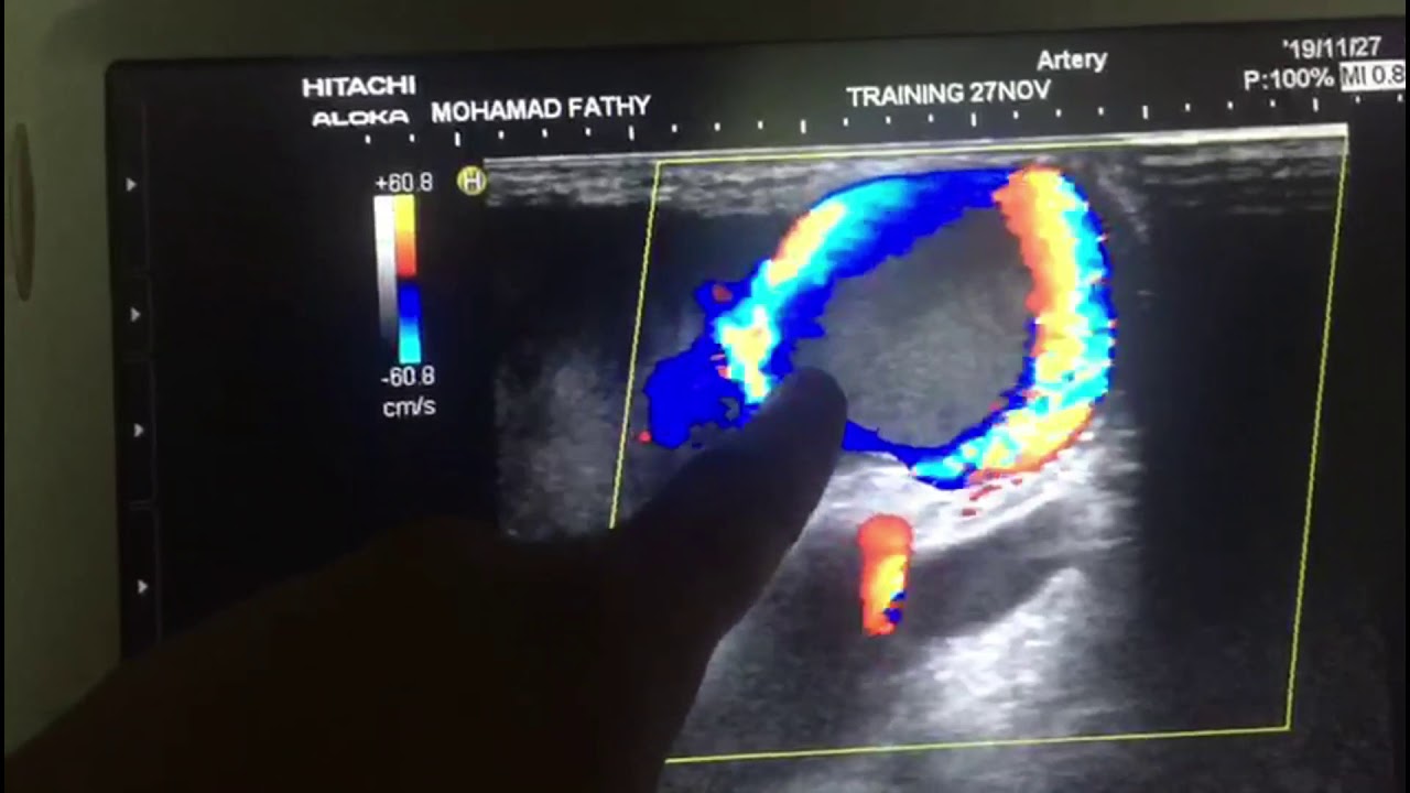 Color Swirl in Venous Side Aneurysm A V F