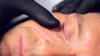 Male fullface treatment of Steve with Restylane and Azzalure
