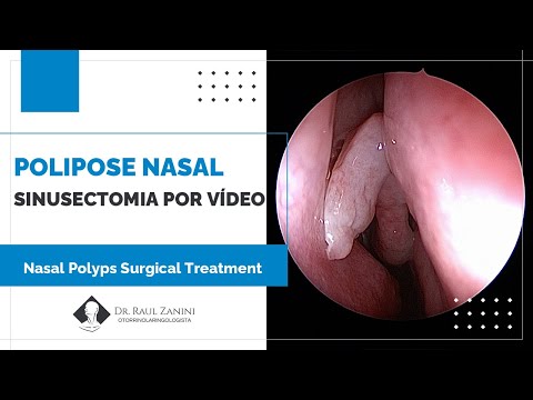 Miniatura: Polipose Nasal - Sinusectomia por Vídeo Endoscopia