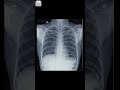 Normal Lung Vs Infected Lungs Lungs Chest Radiology Xray Neet Radiology Medicos Doctor