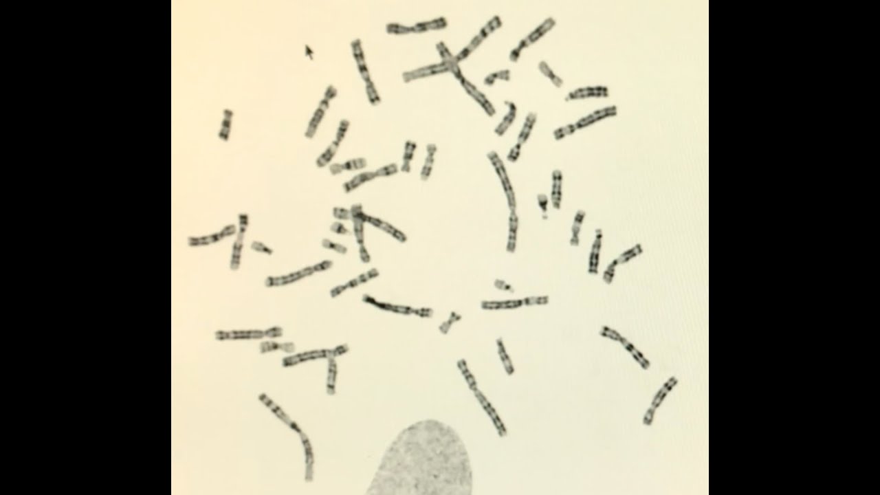 Ricostruzione di un cariotipo umano con bandeggio G