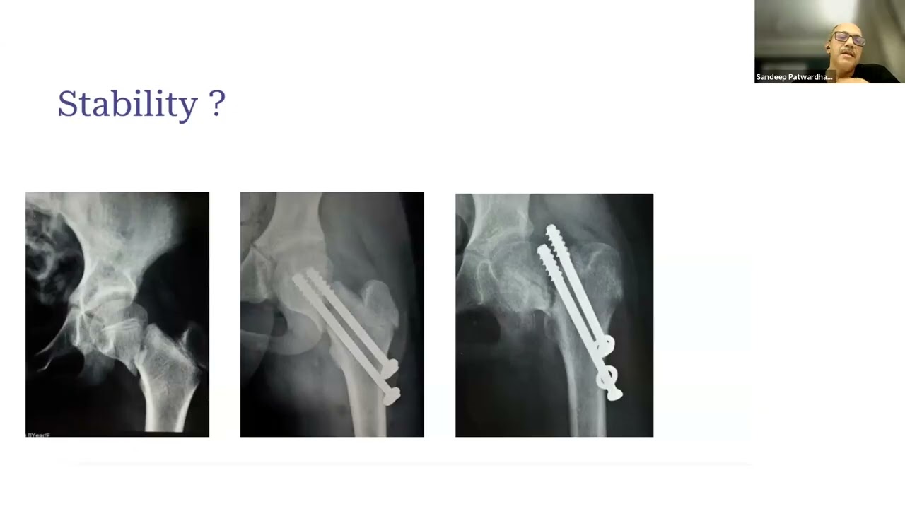 2025 UCSF IGOT Pediatric Limb Differences Webinar – Session 4: JUGAAD Technical & Frugal Innovation