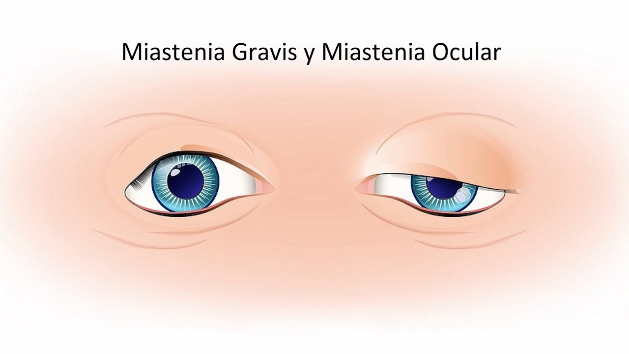 Miastenia Gravis y Miastenia Ocular