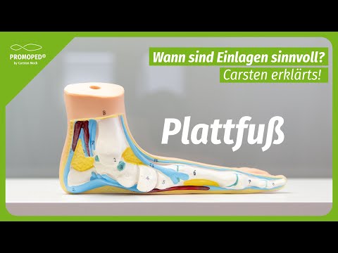 Plattfuß erklärt: Alles, was Du wissen musst!
