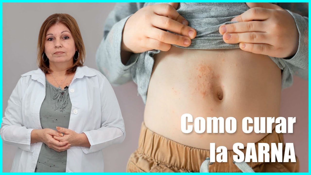 Watch 🔸Cómo curar la SARNA Humana 😖 Tratamiento de la Escabiosis en una sola DOSIS ✅ Now 🔸Cómo curar la SARNA Humana 😖 Tratamiento de la Escabiosis en una sola DOSIS ✅