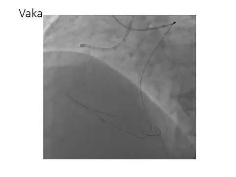 Adım adım retrograd CTO/step by step retrograde cto