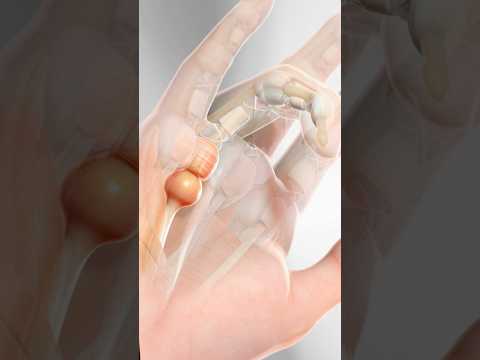 Trigger Finger (3D Animation)