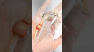 Trigger Finger (3D Animation)